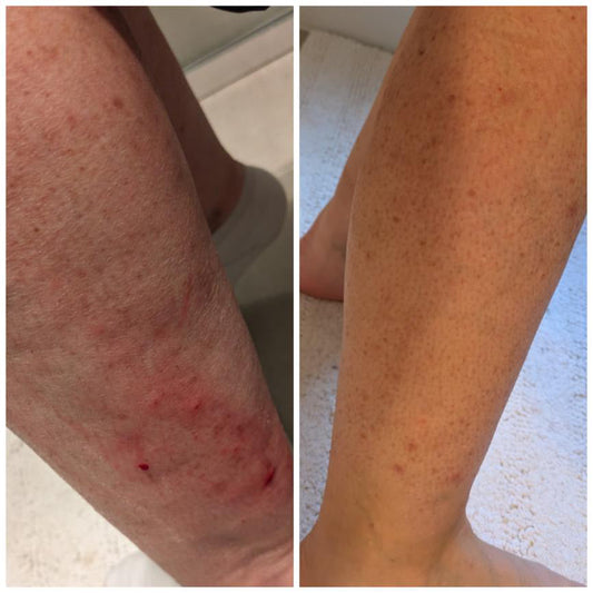 Tallow for Eczema: What It Is, Why It Works, and What to Expect