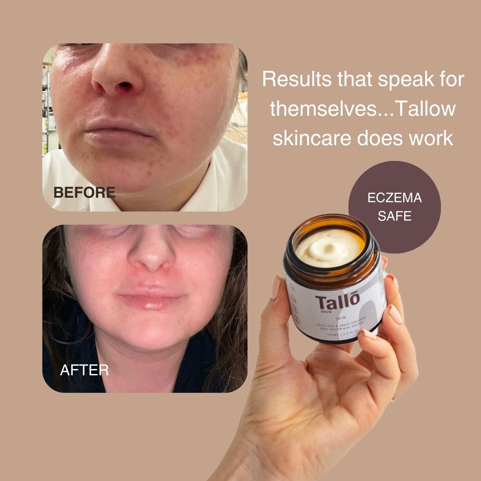 Before and after comparison of a person's skin with Tallow skincare, showing eczema-safe product.