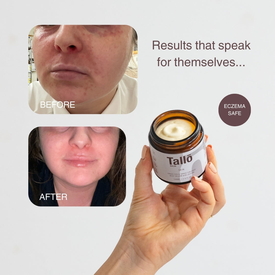 Skin Tallow Cream (Eczema & Psoriasis Safe)