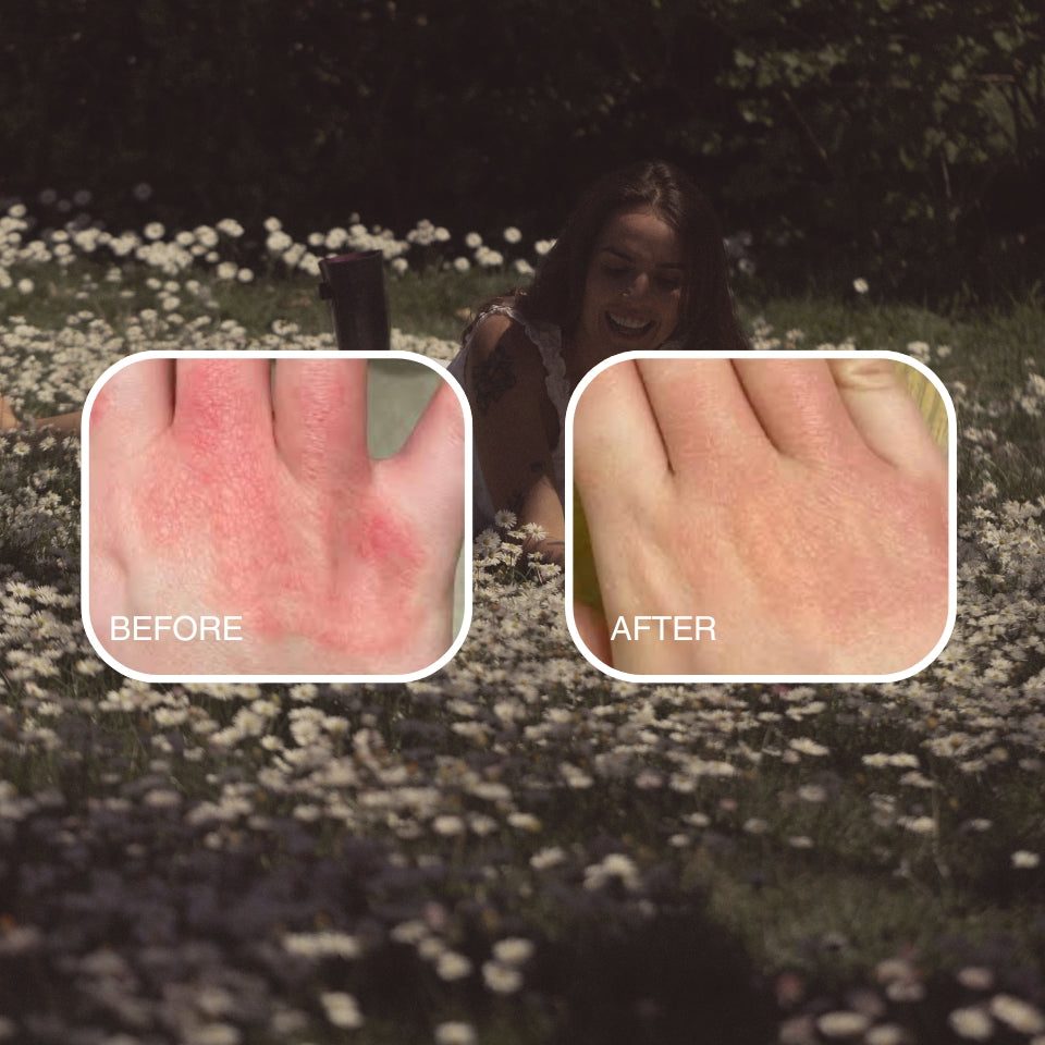 Skin Tallow Cream (Eczema & Psoriasis Safe)